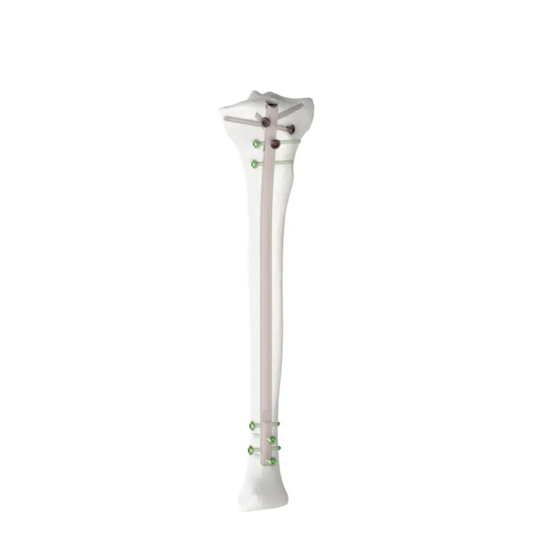 Clavo intramedular para tibia Expert | Implante ortopédico de titanio