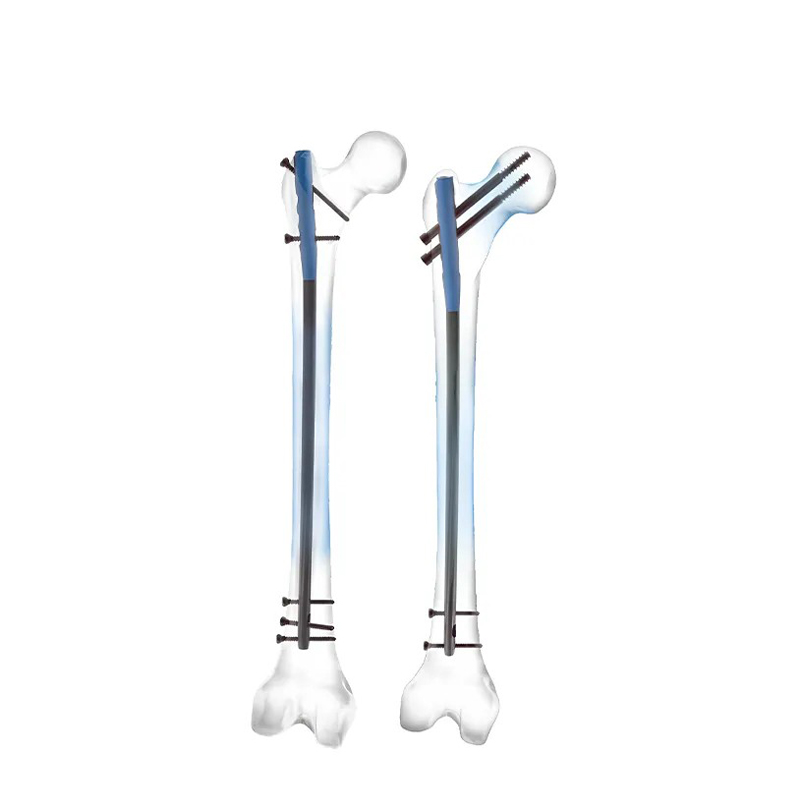 Clavo intramedular femoral experto