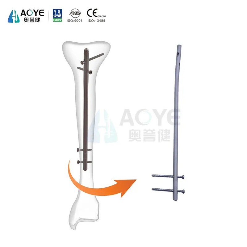 Clavo intramedual tibial
