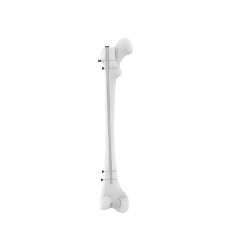 Clavo intramedual femoral