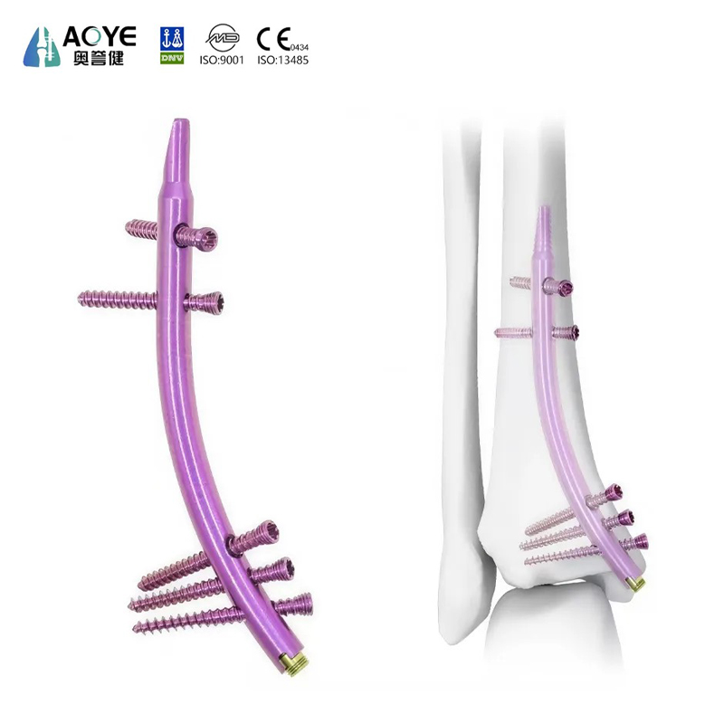 Clavo intramedular tibial distal (DTN)