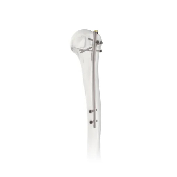 Clavo intramedular humeral